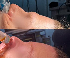 Forehead Contouring in Facial Feminization | Maxillofacial Surgeon in Mexico