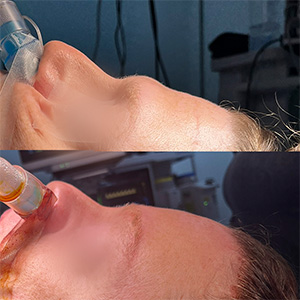 Forehead Contouring in Facial Feminization | Maxillofacial Surgeon in Mexico