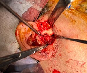 Temporomandibular Joint (TMJ): when surgery becomes necessary