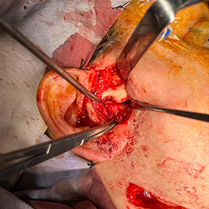 Temporomandibular Joint (TMJ): when surgery becomes necessary